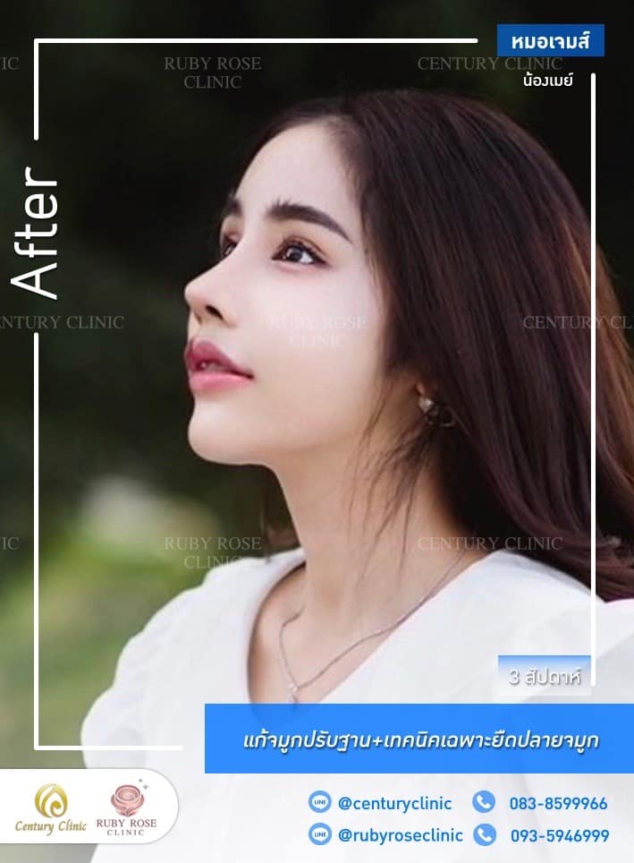 รีวิว แก้จมูก #461 , Century Clinic Thailand Century-รีวิว-แก้จมูก #461