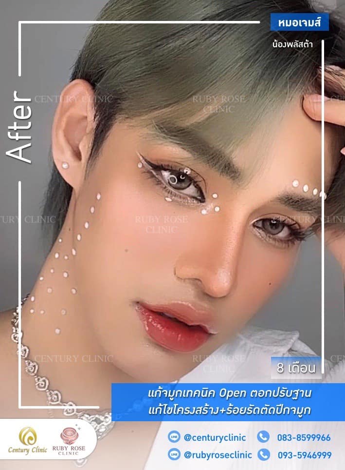 รีวิว แก้จมูก #470 , Century Clinic Thailand Century-รีวิว-แก้จมูก #470