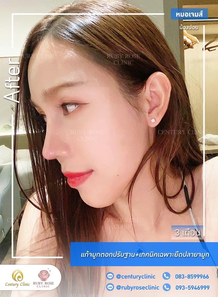 Century-รีวิว-แก้จมูก #475