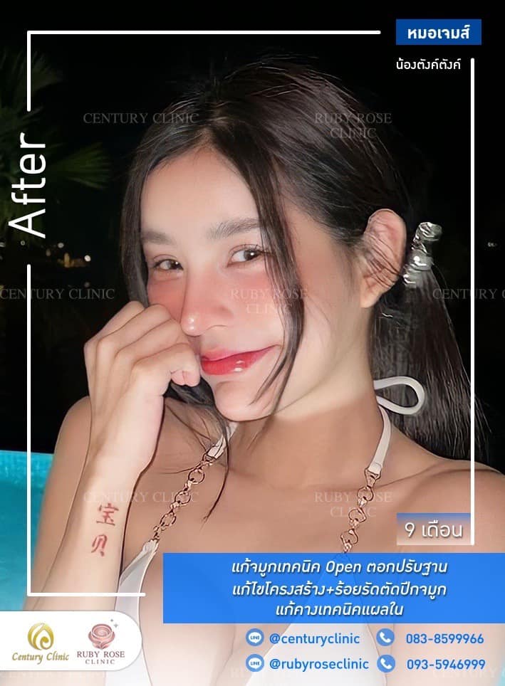 Century-รีวิว-แก้จมูก #480