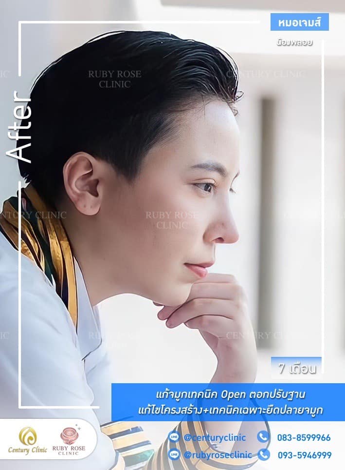 Century-รีวิว-แก้จมูก #494