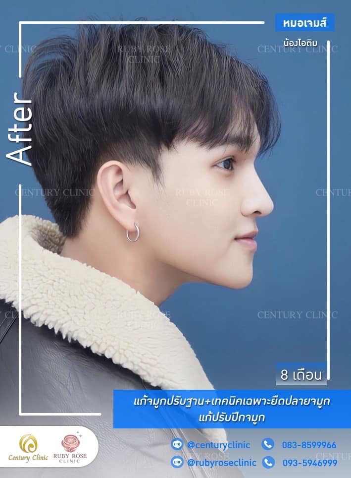 Century-รีวิว-แก้จมูก #509