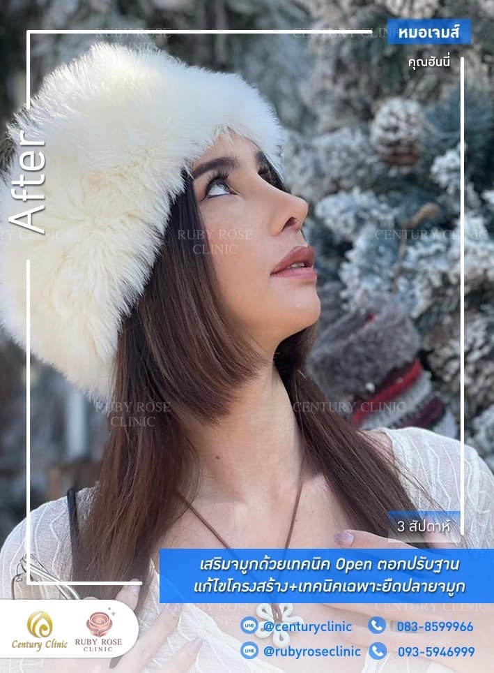 Century-รีวิว-เสริมจมูก 1#514