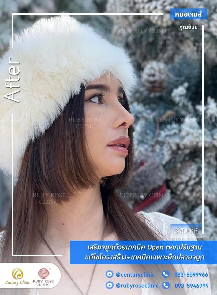 Century-รีวิว-เสริมจมูก #514