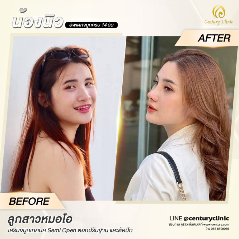 Century-รีวิว-เสริมจมูก #568