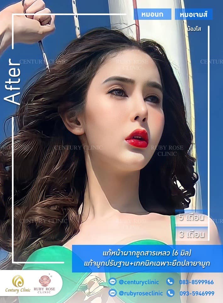 รีวิว แก้จมูก #510 , Century Clinic Thailand Century-รีวิว-แก้จมูก 1#510