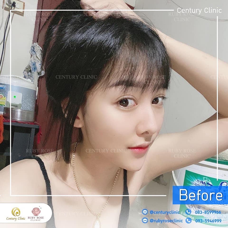 Century-รีวิว-แก้จมูก 1#529