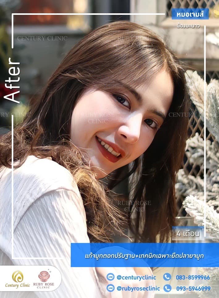 รีวิว แก้จมูก #534 , Century Clinic Thailand Century-รีวิว-แก้จมูก 1#534