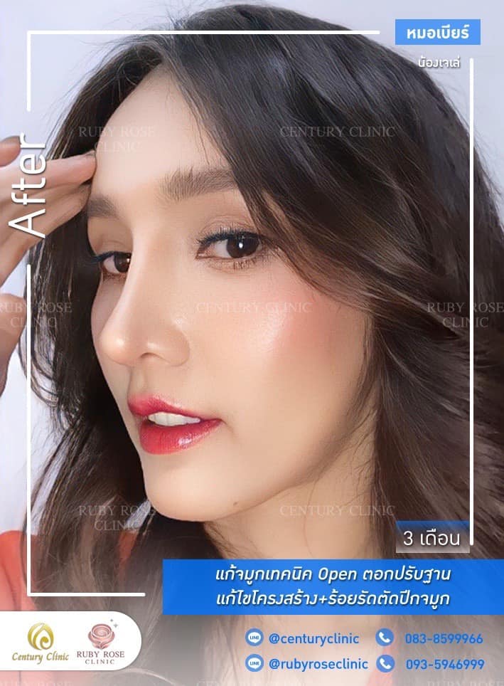 Century-รีวิว-แก้จมูก #512