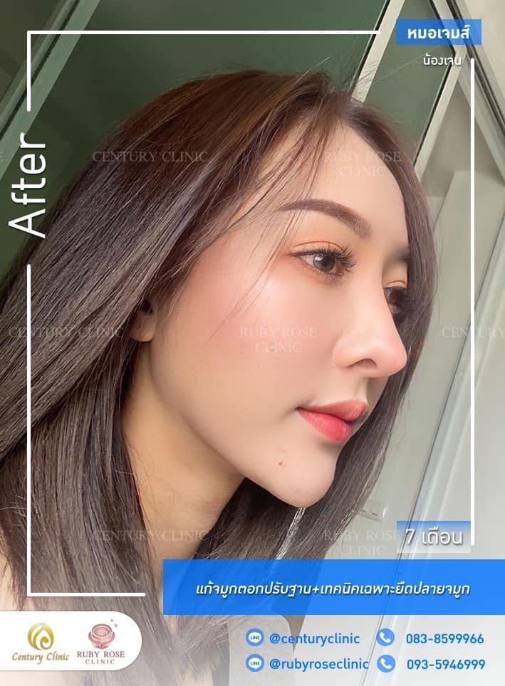 Century-รีวิว-แก้จมูก #529