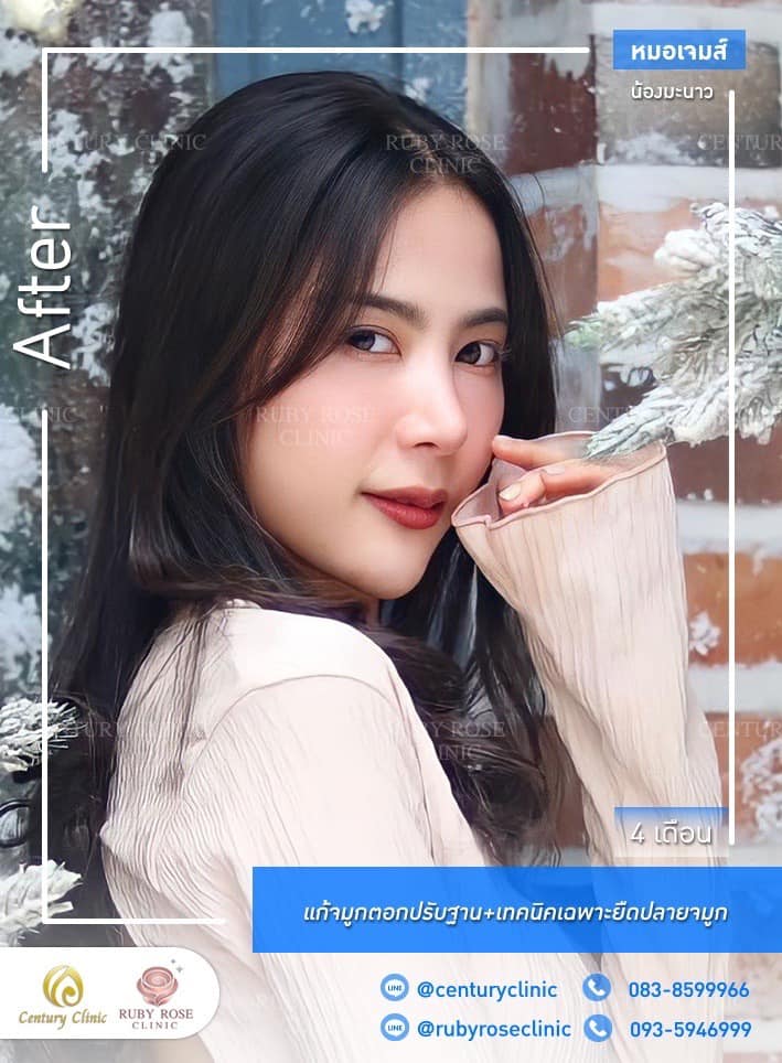รีวิว แก้จมูก #534 , Century Clinic Thailand Century-รีวิว-แก้จมูก #534