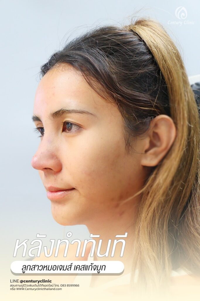 Century-รีวิว-แก้จมูก #538