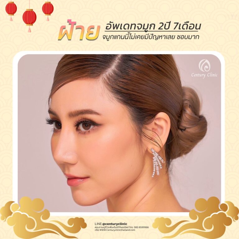 Century-รีวิว-แก้จมูก #546