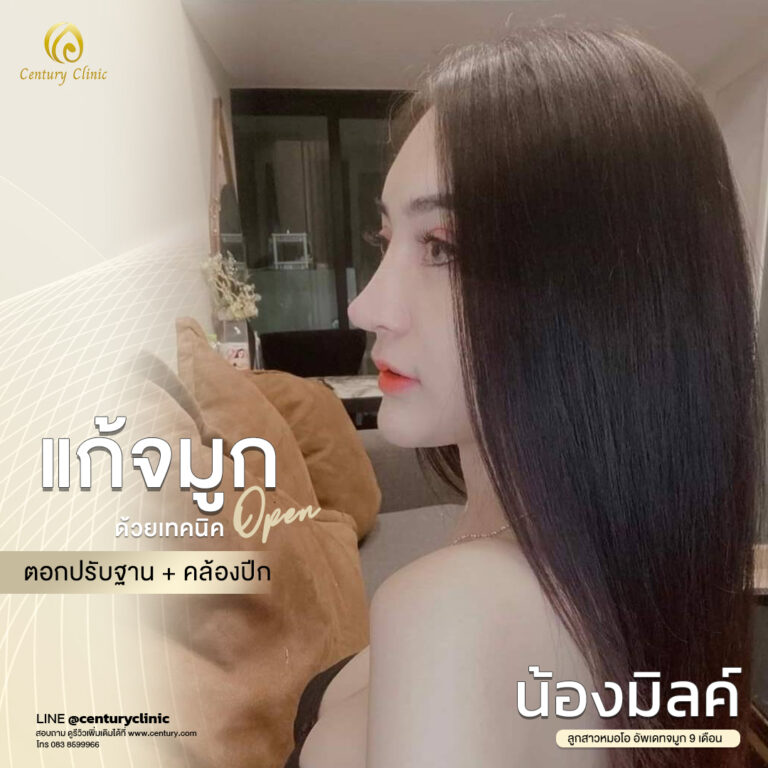 Century-รีวิว-แก้จมูก #554