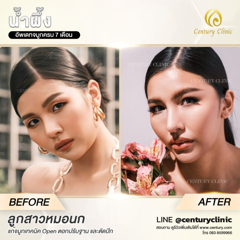 Century-รีวิว-แก้จมูก #566