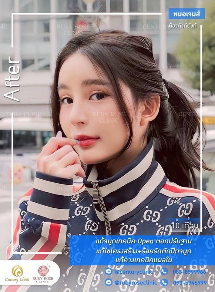 Century-รีวิว-แก้จมูก-คาง 1#519