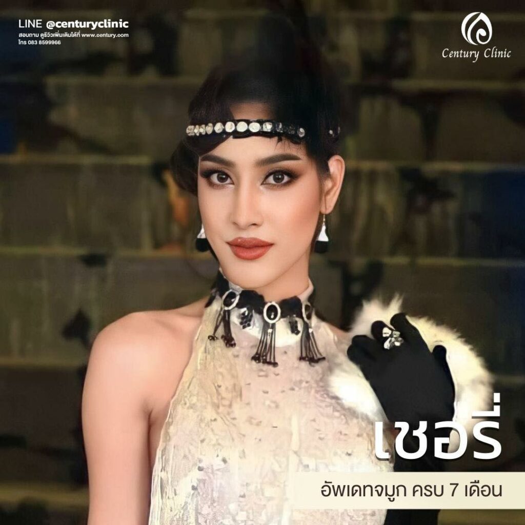 รีวิว เสริมจมูก #582 , Century Clinic Thailand Century-รีวิว-เสริมจมูก 2#582