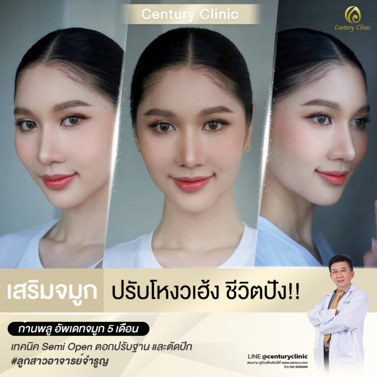 Century-รีวิว-เสริมจมูก #588