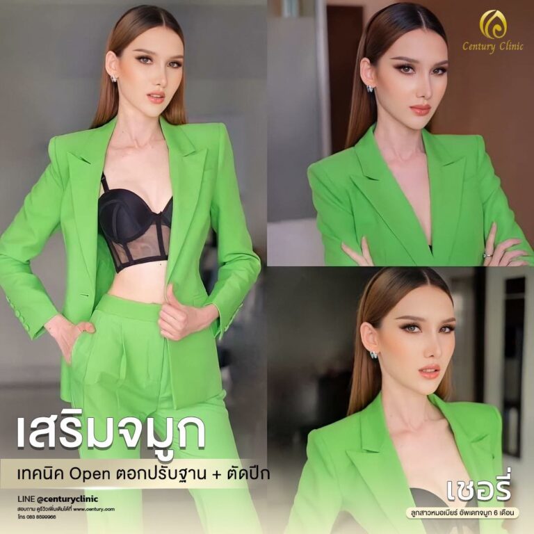 Century-รีวิว-เสริมจมูก #592