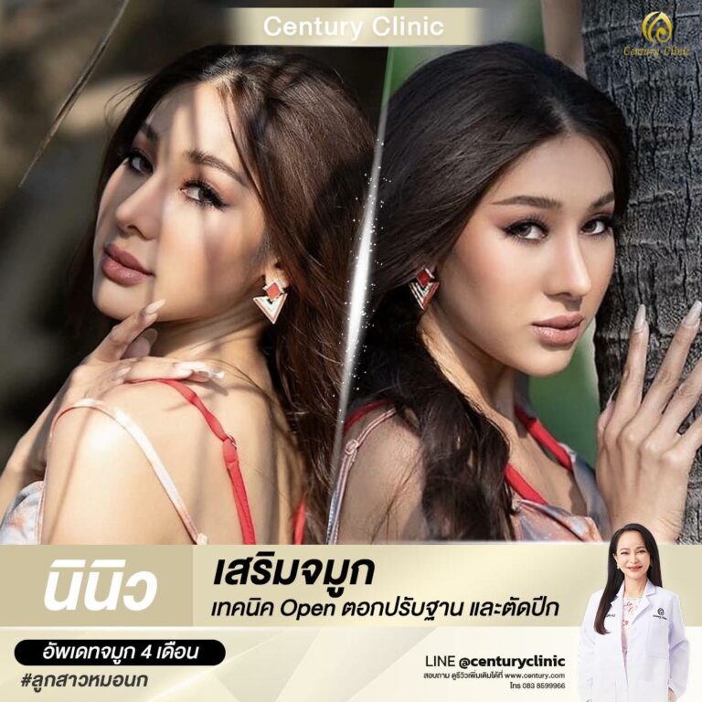 Century-รีวิว-เสริมจมูก #594