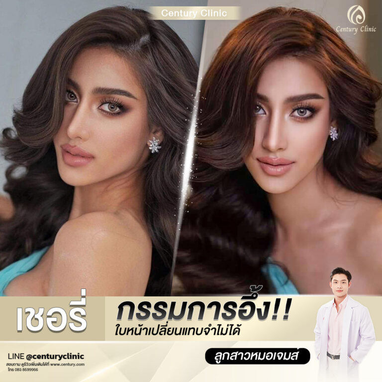 Century-รีวิว-เสริมจมูก #609