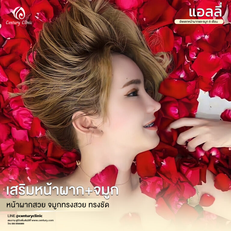 Century-รีวิว-เสริมจมูก #619