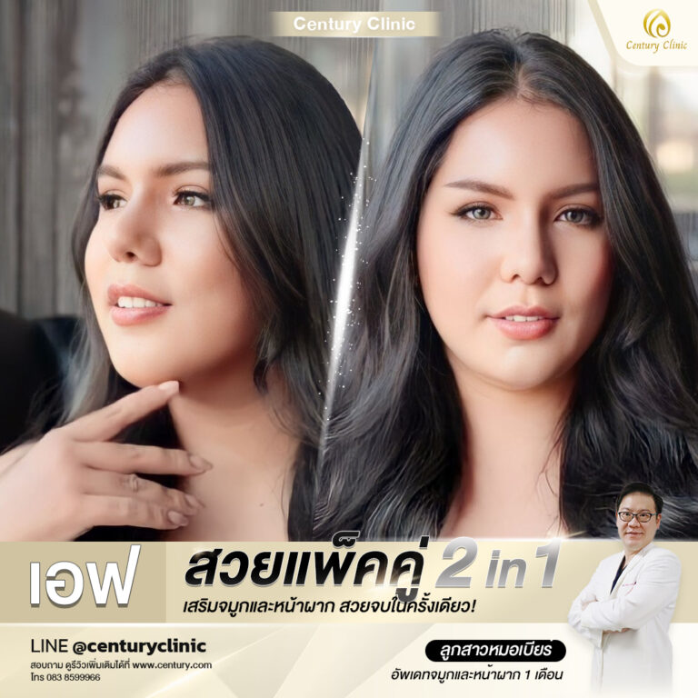 Century-รีวิว-เสริมจมูก-หน้าผาก#617