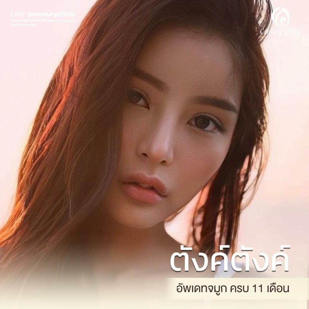 Century-รีวิว-แก้จมูก 2#584