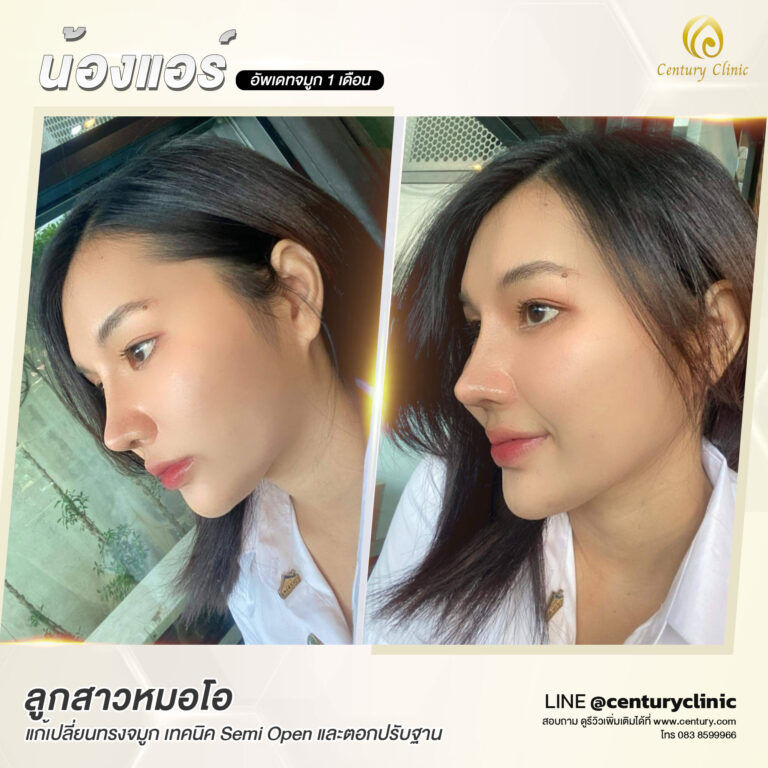 Century-รีวิว-แก้จมูก #575