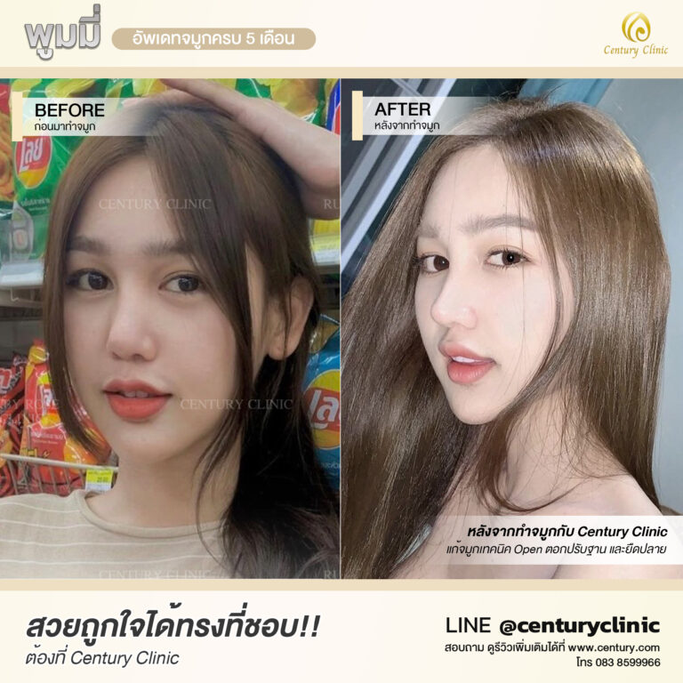 Century-รีวิว-แก้จมูก #577