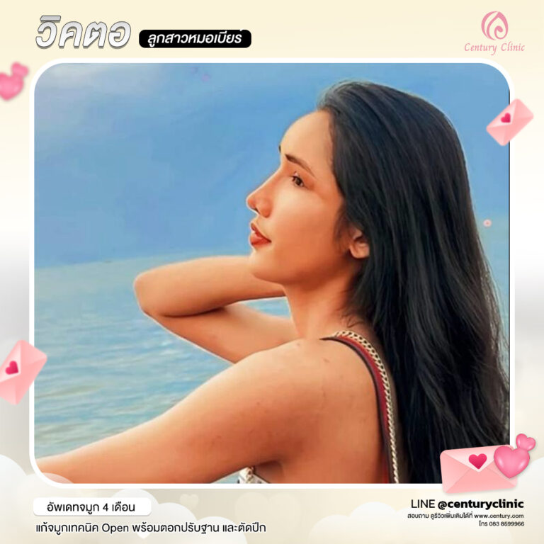 Century-รีวิว-แก้จมูก #581
