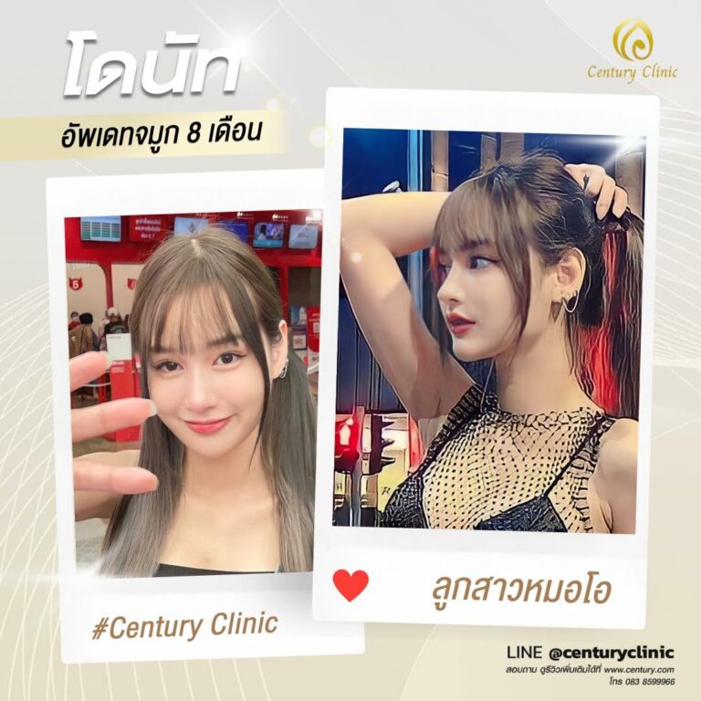 Century-รีวิว-แก้จมูก #586
