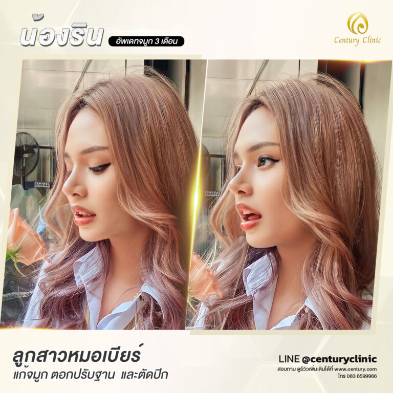 Century-รีวิว-แก้จมูก #602
