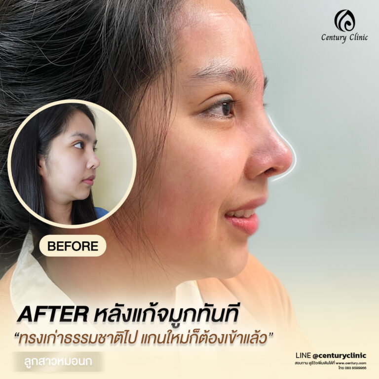 Century-รีวิว-แก้จมูก #605