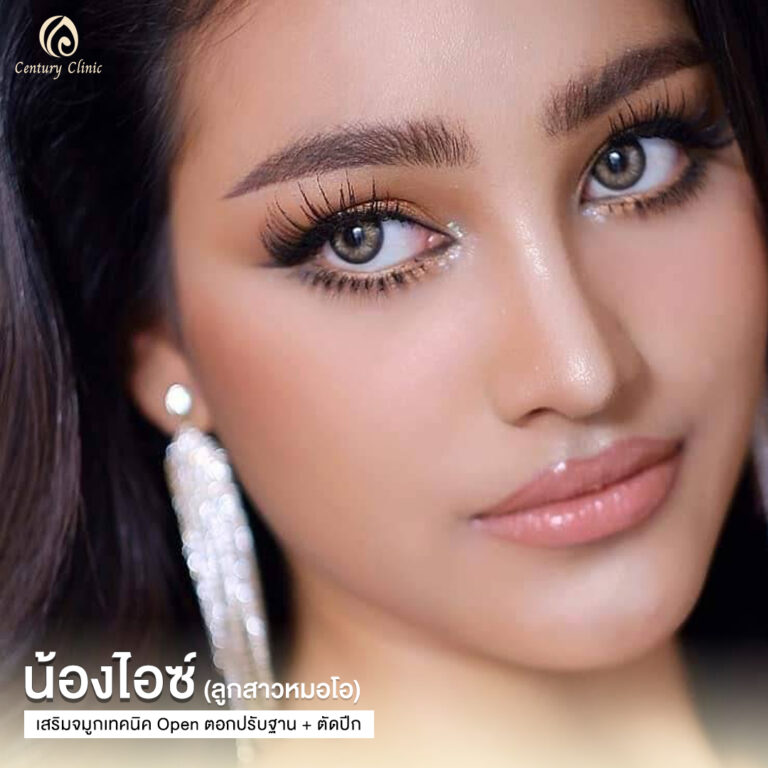 Century-รีวิว-เสริมจมูก #639
