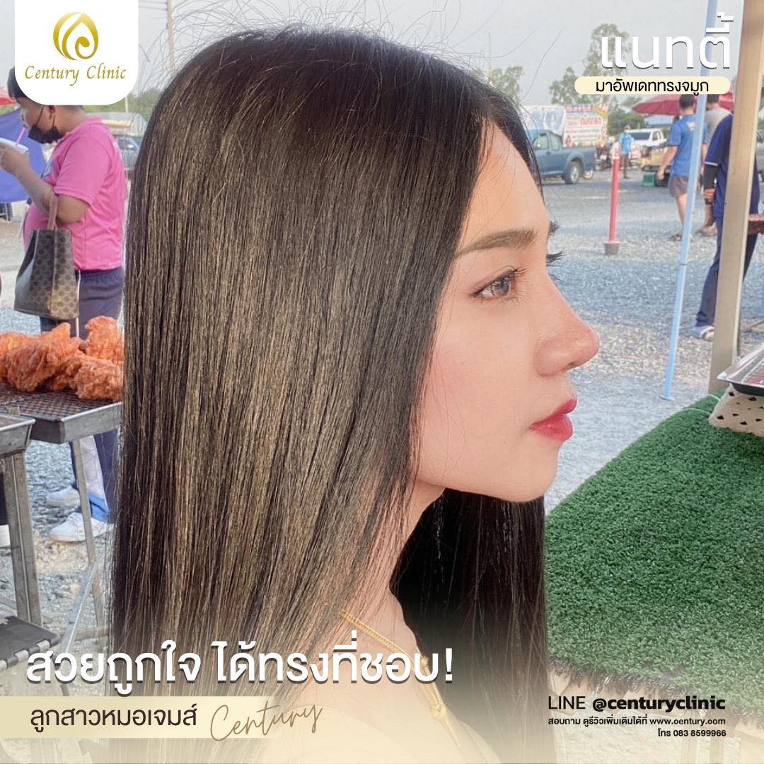 Century-รีวิว-เสริมจมูก #641