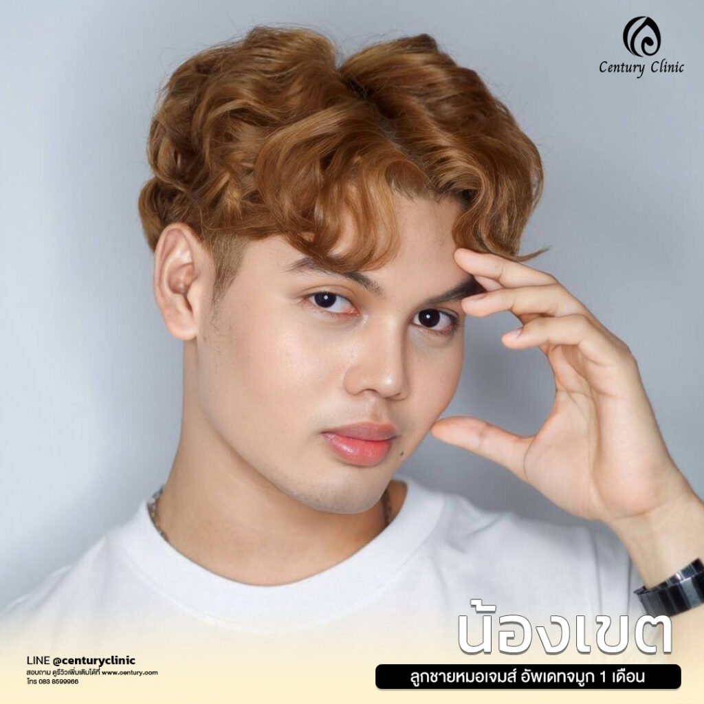 รีวิว แก้จมูก #633 , Century Clinic Thailand Century-รีวิว-แก้จมูก 1#633