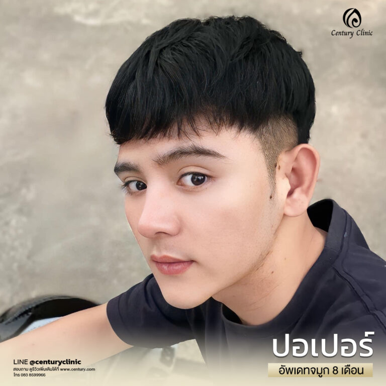 Century-รีวิว-แก้จมูก #622