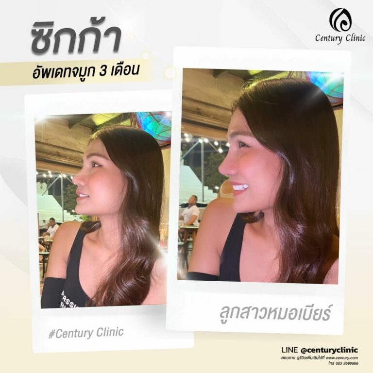 Century-รีวิว-แก้จมูก #624