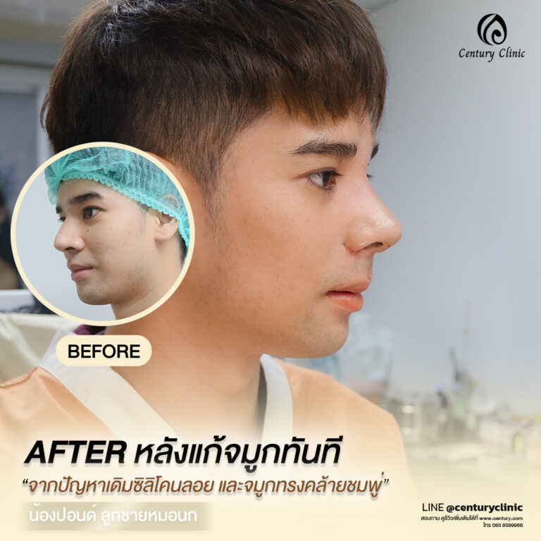 Century-รีวิว-แก้จมูก #627