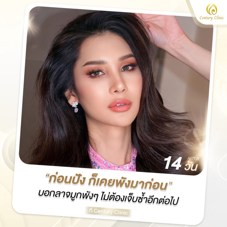 Century-รีวิว-แก้จมูก #634