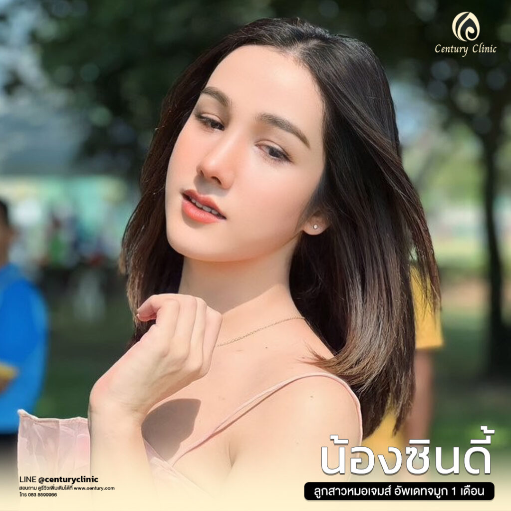 รีวิว แก้จมูก #645 , Century Clinic Thailand Century-รีวิว-แก้จมูก #645
