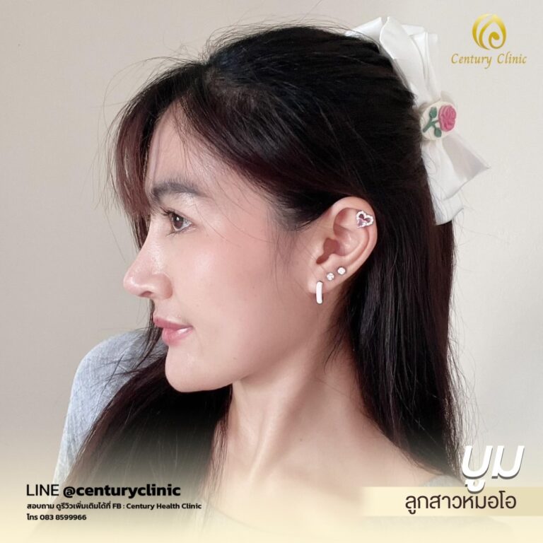 Century-รีวิว-แก้จมูก #660