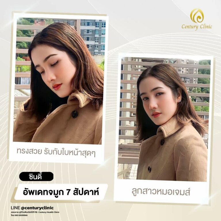 Century-รีวิว-เสริมจมูก #665