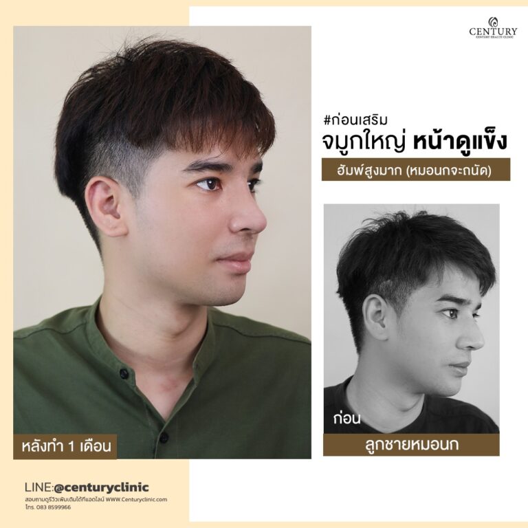 Century-รีวิว-เสริมจมูก #673
