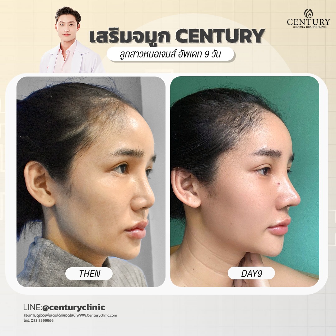 รีวิว เสริมจมูก #677 , Century Clinic Thailand Century-รีวิว-เสริมจมูก #677