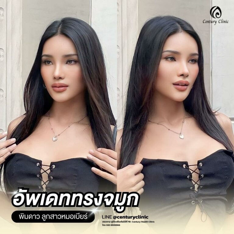 Century-รีวิว-เสริมจมูก #684