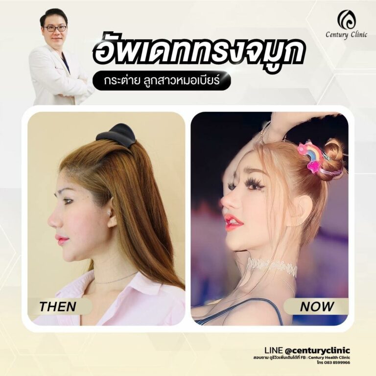 Century-รีวิว-เสริมจมูก #686