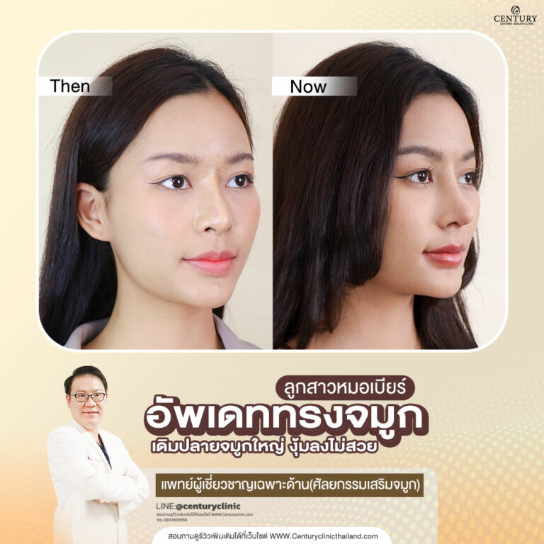 Century-รีวิว-แก้จมูก #676