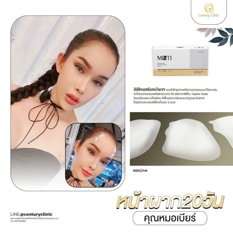 Review แก้หน้าผาก #25